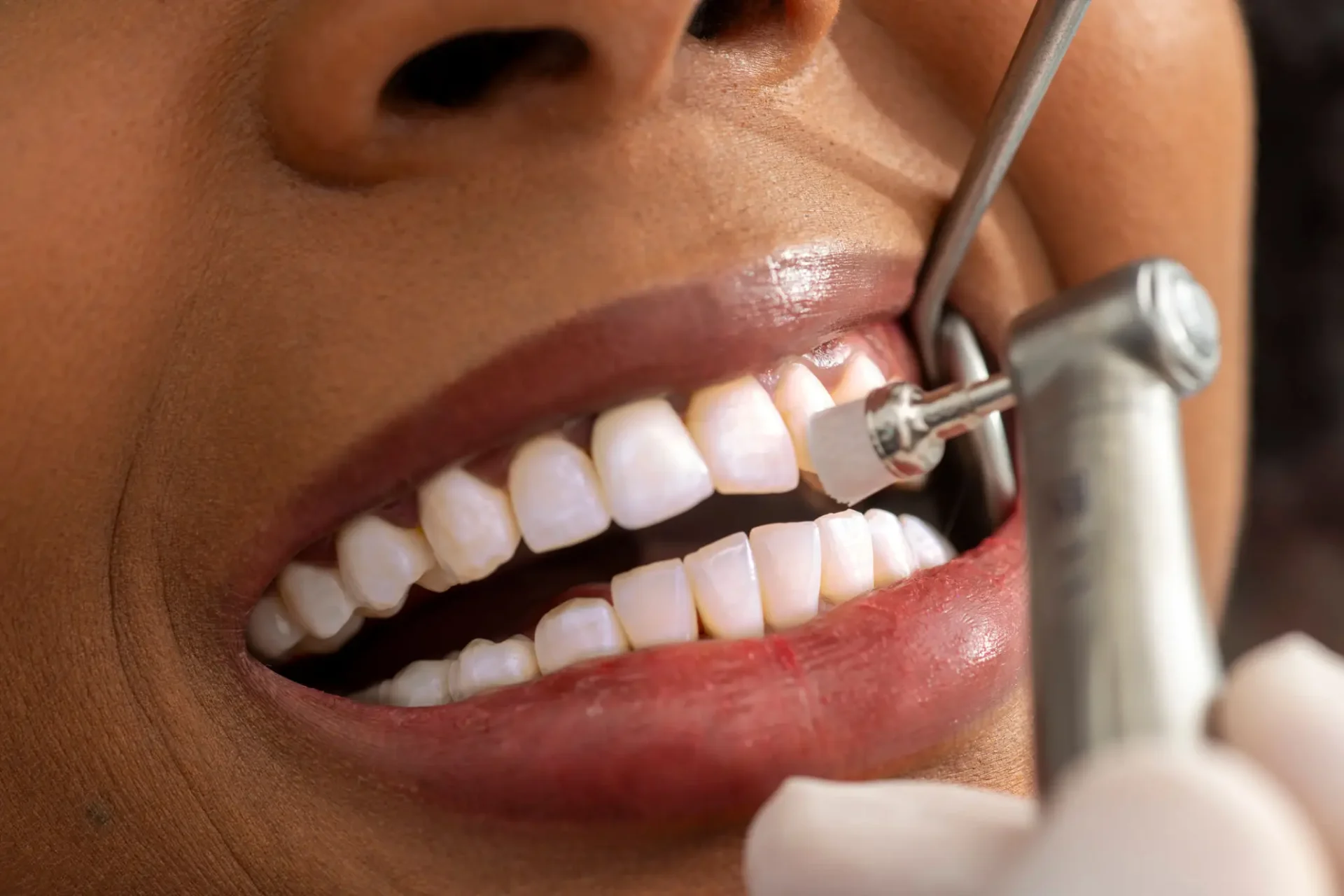 Dentist polishing patient's teeth